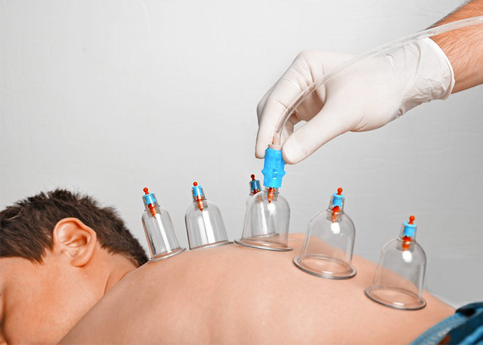 When is cupping done?